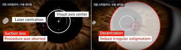 Conventional SMILE LASIK comparison